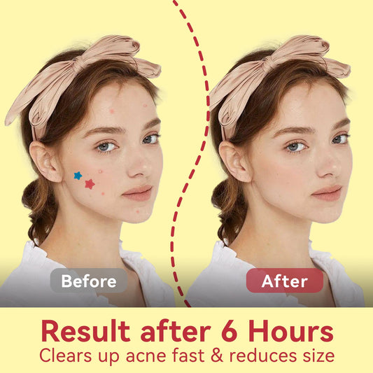 How to Use Pimple Patches: Complete Guide for Best Results