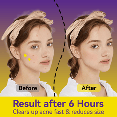 Yellow Star Pimple Patches