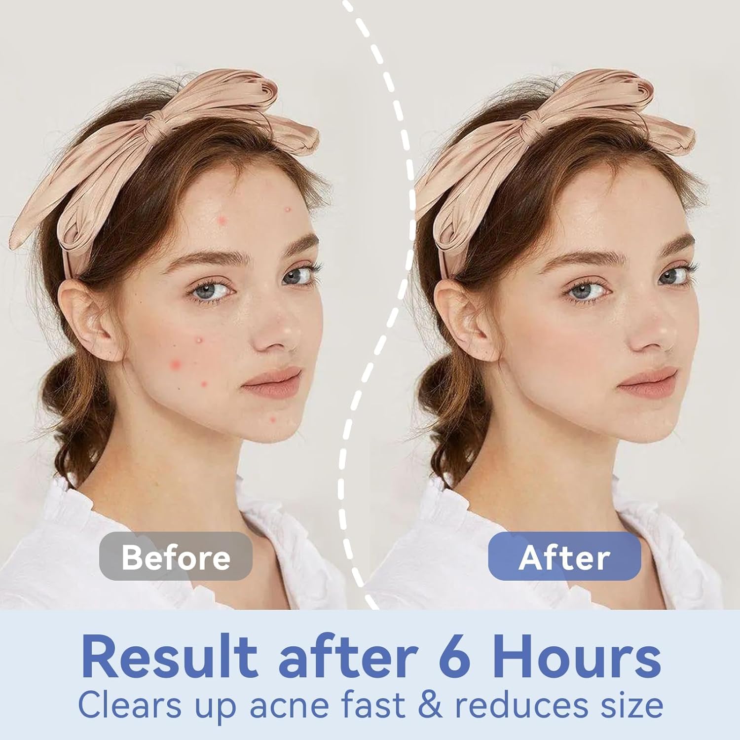 OmaDoto Invisible Pimple Patches - 12mm Hydrocolloid (72 Count) - OmaCare