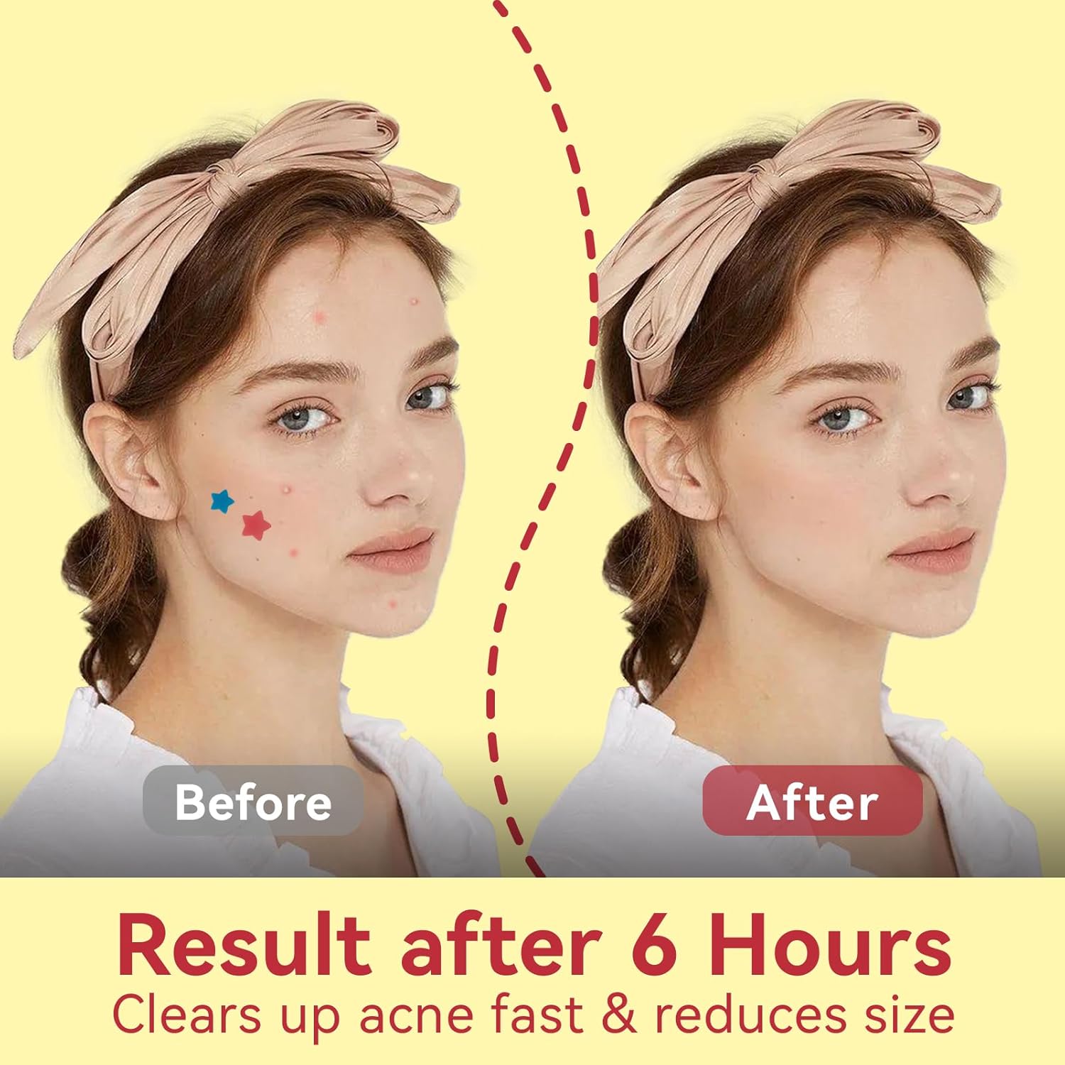 BLACK FRIDAY DEALS UP TO 50%!Star Pimple Patches for Face - 6 Colors 66Pcs (14mm) Hydrocolloid - OmaCare