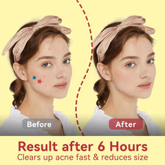 BLACK FRIDAY DEALS UP TO 50%!Star Pimple Patches for Face - 6 Colors 66Pcs (14mm) Hydrocolloid - OmaCare