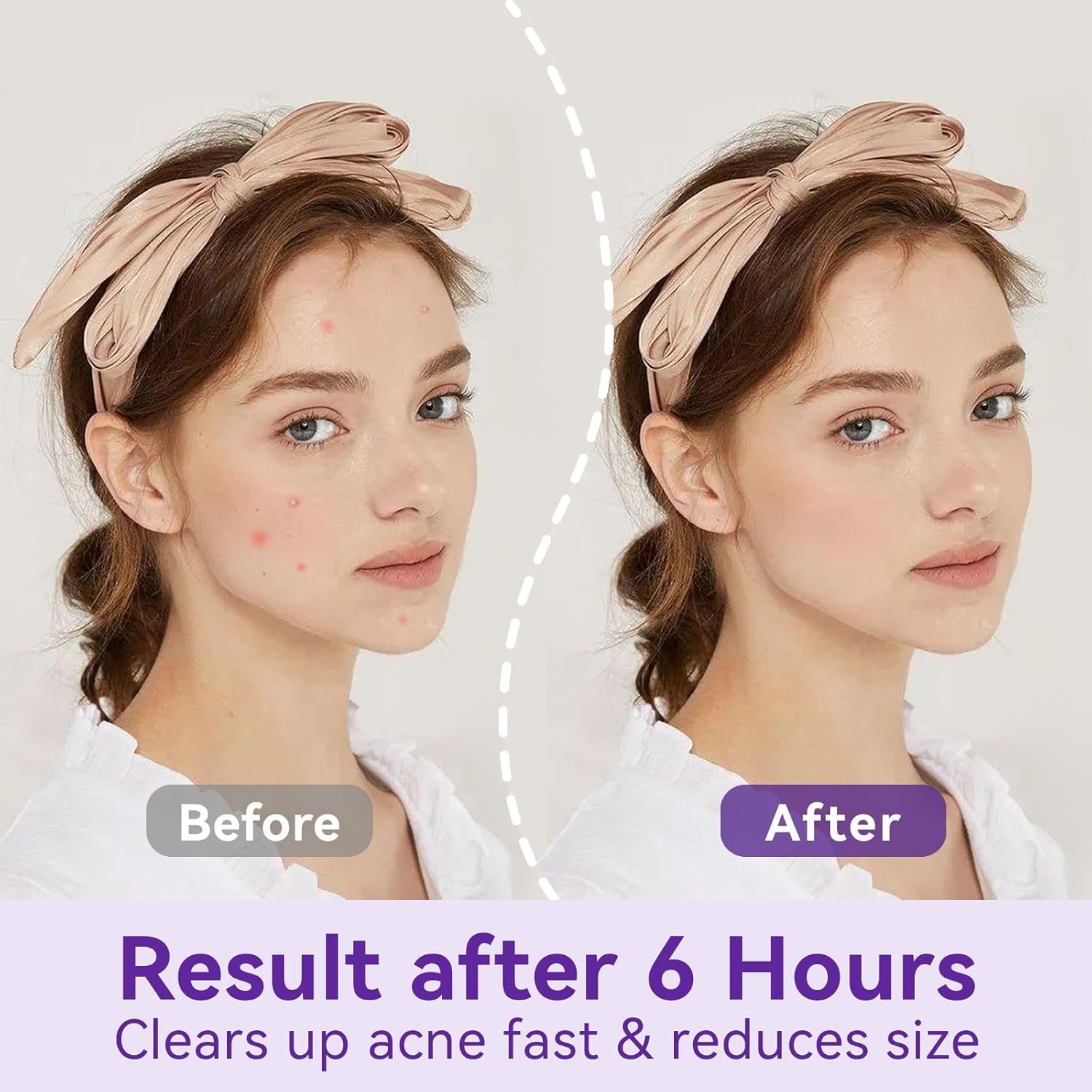 Omadoto Acne Patches - Overnight Pimple Treatment (72 Count) - OmaCare